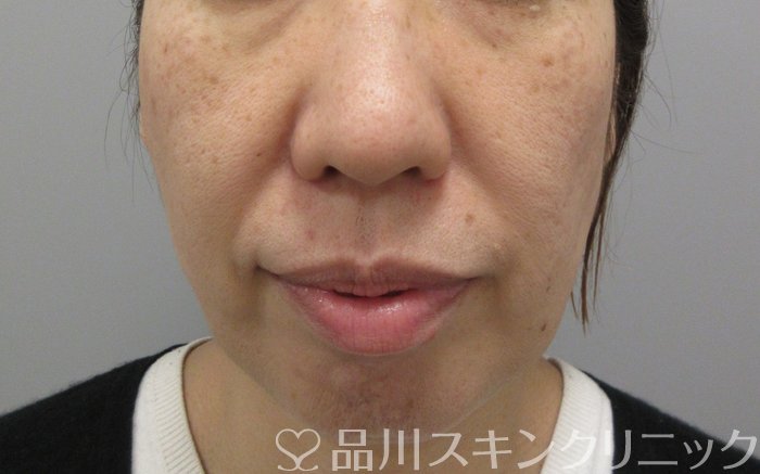 症例NO.70003のBEFORE写真