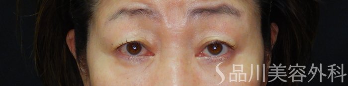 症例NO.65042のBEFORE写真