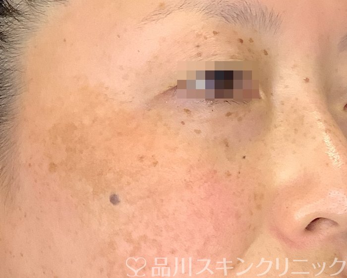 症例NO.70878のAFTER写真