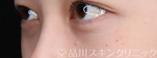 症例NO.65593のAFTER写真