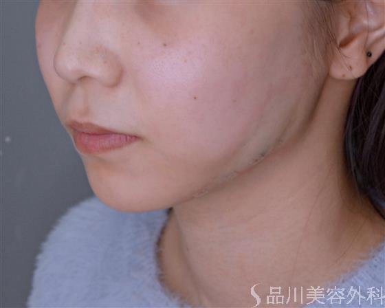 症例NO.53252のAFTER写真