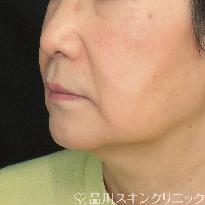 症例NO.75090のBEFORE写真