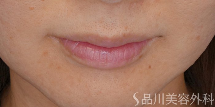 症例NO.72337のBEFORE写真