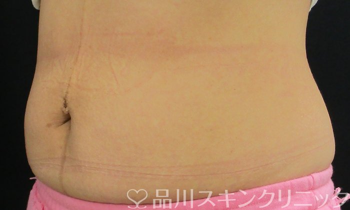 症例NO.74659のAFTER写真