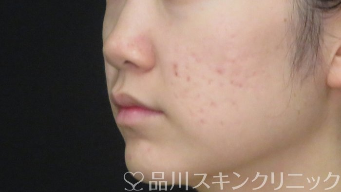 症例NO.72685のAFTER写真