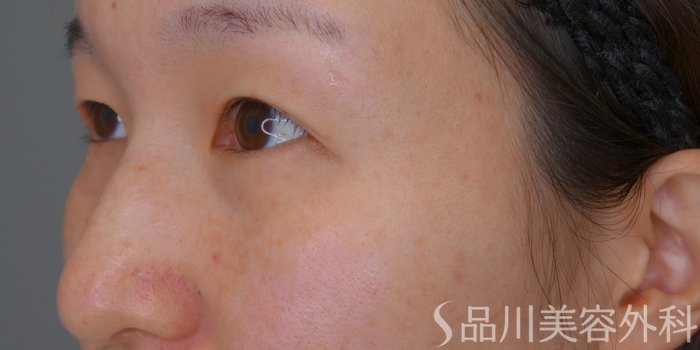 症例NO.74419のBEFORE写真