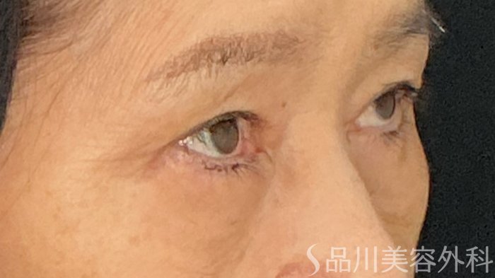 症例NO.71889のAFTER写真