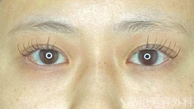症例NO.67642のAFTER写真