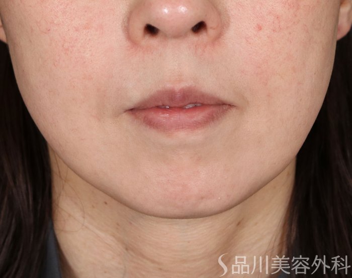 症例NO.71651のBEFORE写真