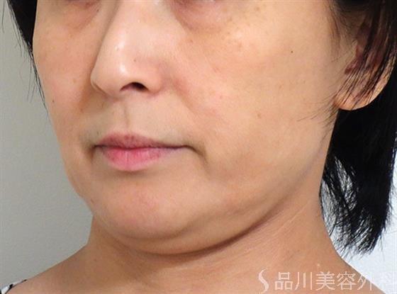 症例NO.25240のBEFORE写真