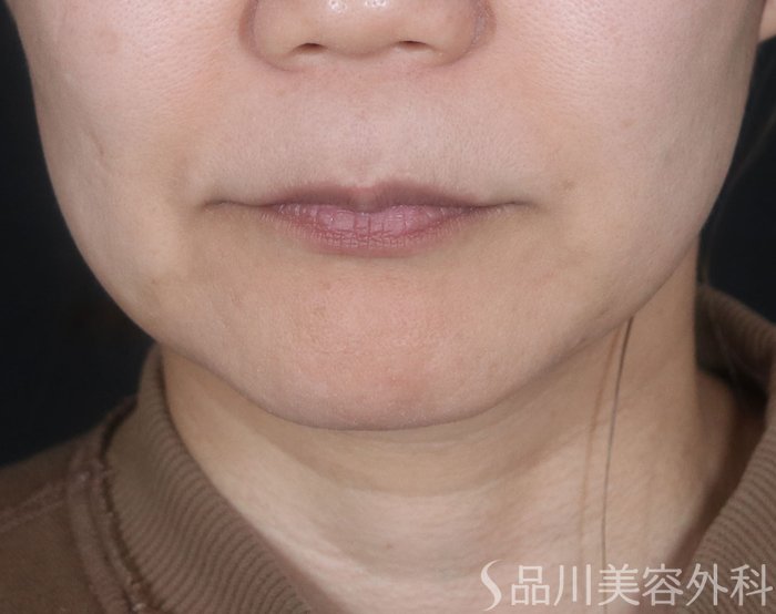 症例NO.73532のBEFORE写真