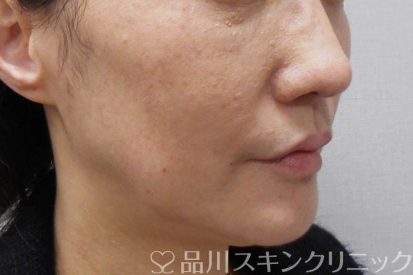 症例NO.69671のBEFORE写真