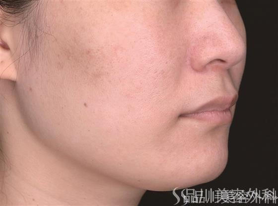 症例NO.65361のBEFORE写真