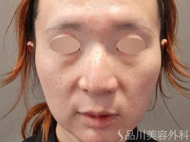 症例NO.74574のBEFORE写真