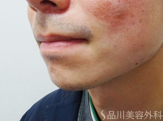 症例NO.71141のBEFORE写真