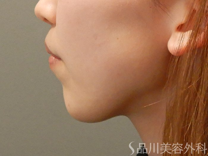 症例NO.67818のBEFORE写真