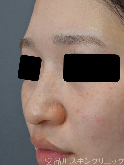 症例NO.75390のBEFORE写真