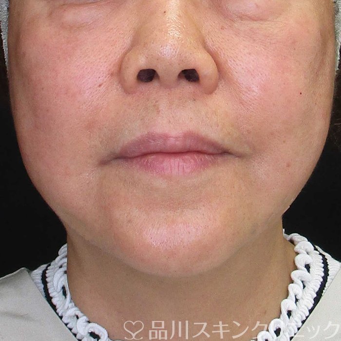 症例NO.69988のAFTER写真