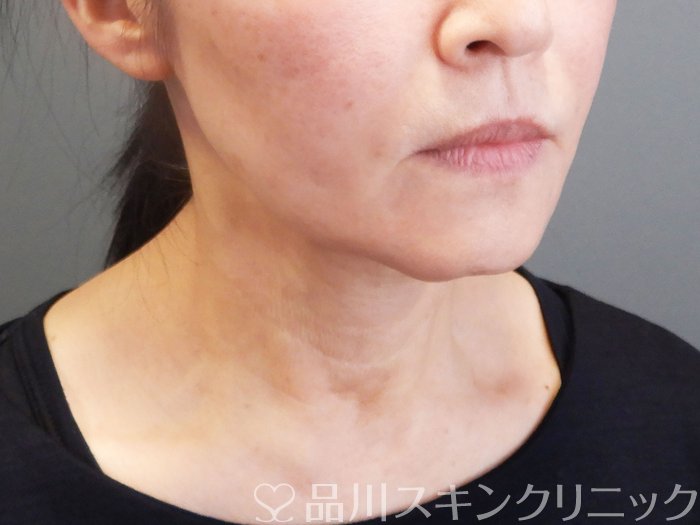 症例NO.74942のAFTER写真