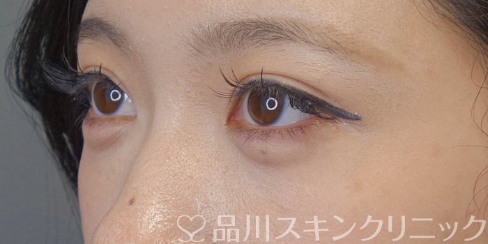 症例NO.74555のAFTER写真