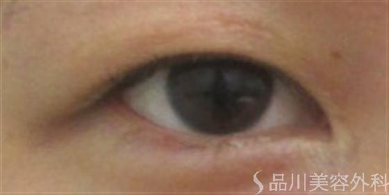 症例NO.15540のBEFORE写真