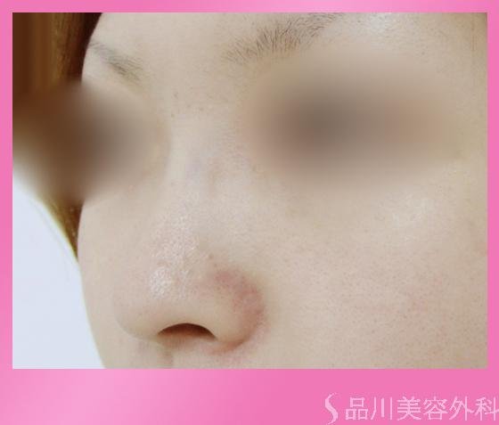 症例NO.2059のBEFORE写真