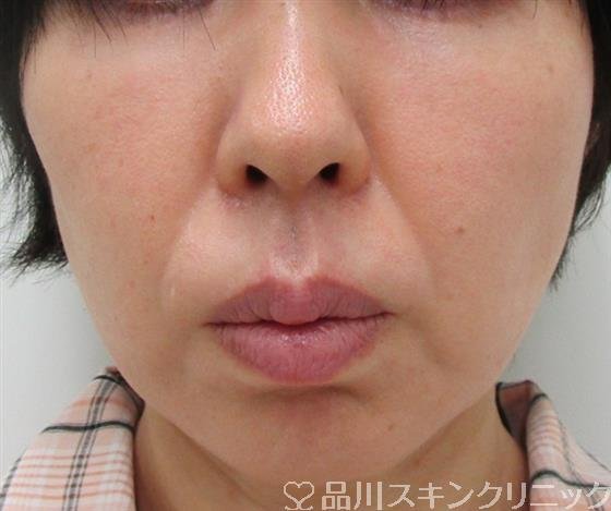 症例NO.30749のBEFORE写真
