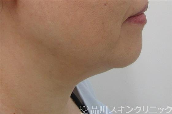 症例NO.42236のBEFORE写真