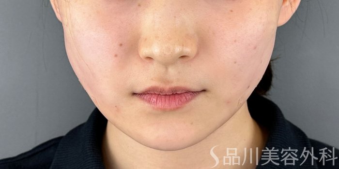 症例NO.70252のAFTER写真