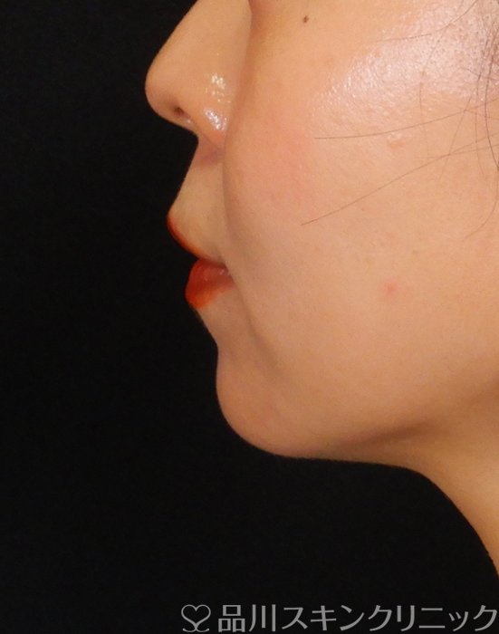 症例NO.66958のBEFORE写真