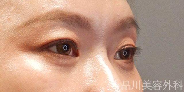 症例NO.73297のAFTER写真