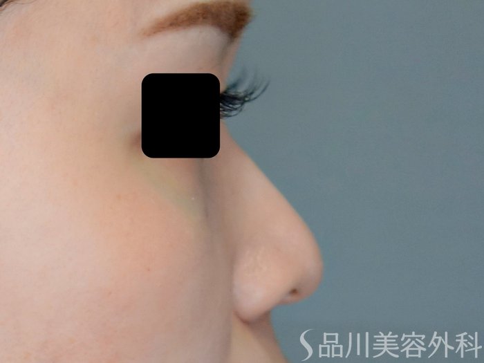 症例NO.71124のBEFORE写真