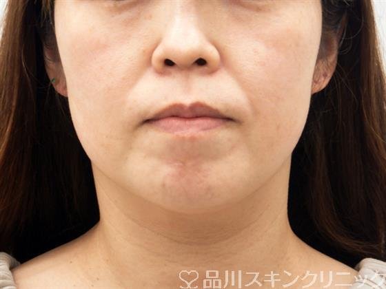 症例NO.53401のBEFORE写真