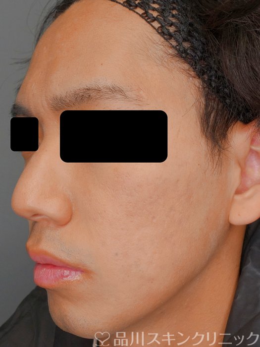 症例NO.73214のAFTER写真