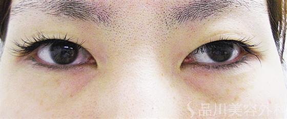 症例NO.13914のBEFORE写真