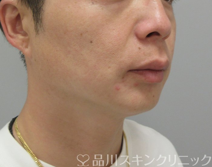 症例NO.73746のBEFORE写真