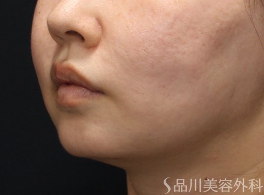 症例NO.75180のAFTER写真