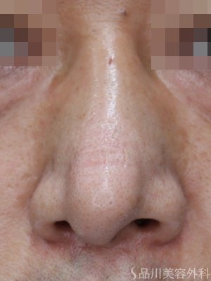 症例NO.69333のBEFORE写真