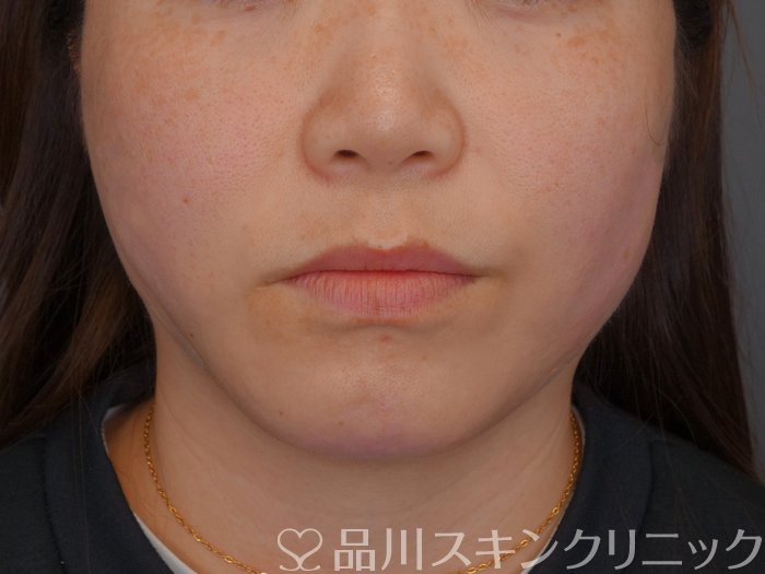 症例NO.74567のAFTER写真