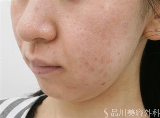 症例NO.30674のAFTER写真