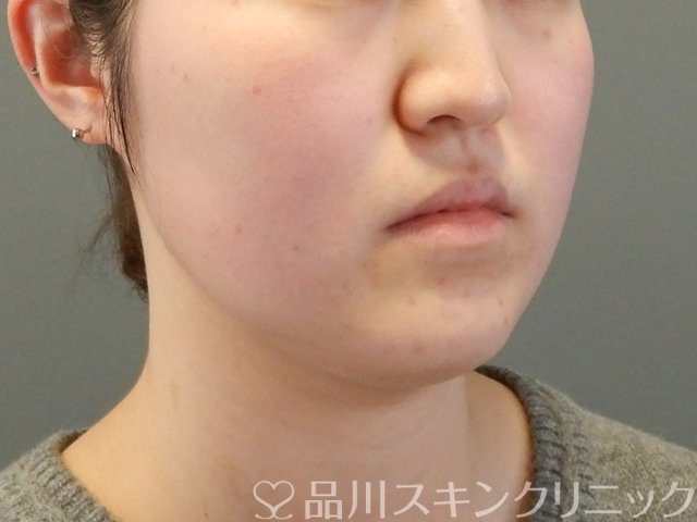 症例NO.64240のBEFORE写真