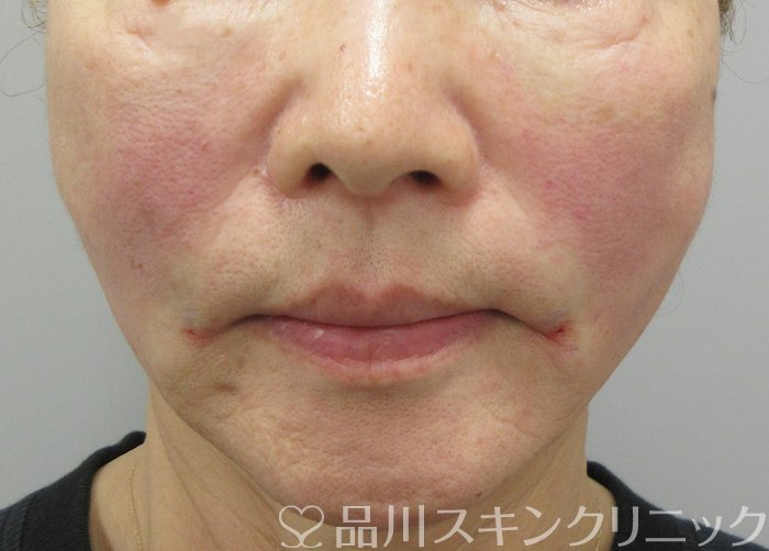 症例NO.72090のAFTER写真