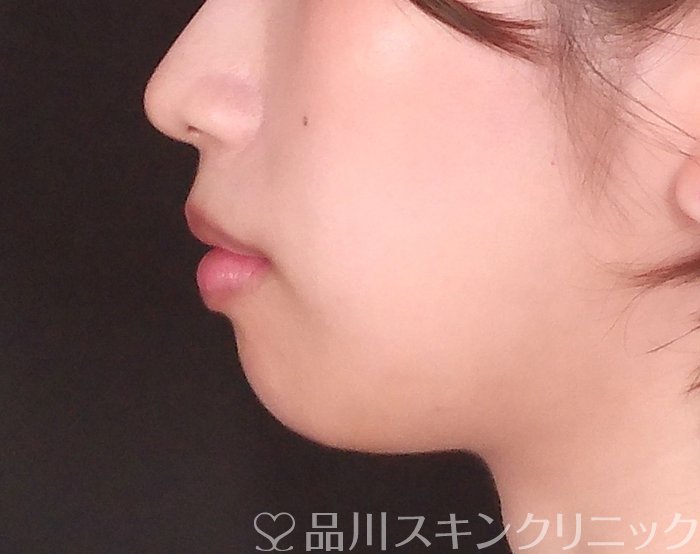 症例NO.70135のBEFORE写真
