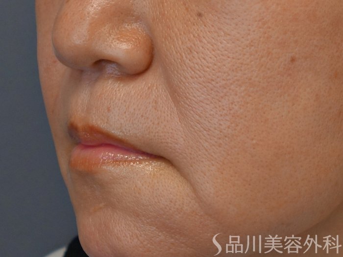 症例NO.71686のBEFORE写真
