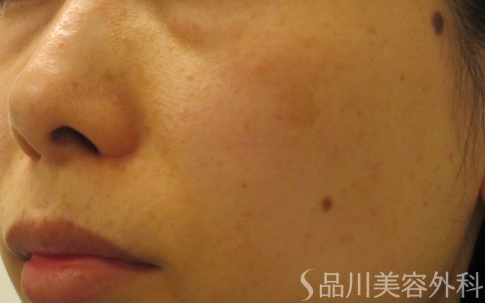 症例NO.70614のBEFORE写真