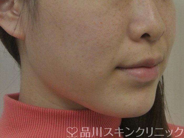 症例NO.69336のAFTER写真