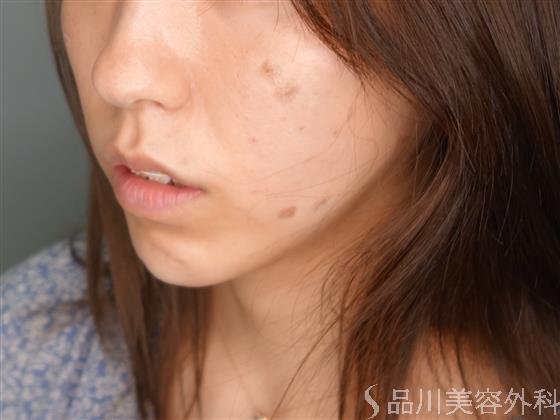 症例NO.51427のAFTER写真
