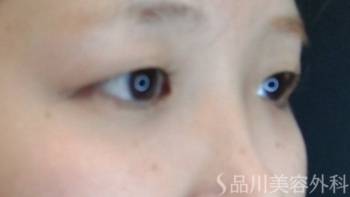 症例NO.71261のBEFORE写真