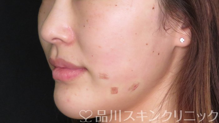 症例NO.71011のAFTER写真