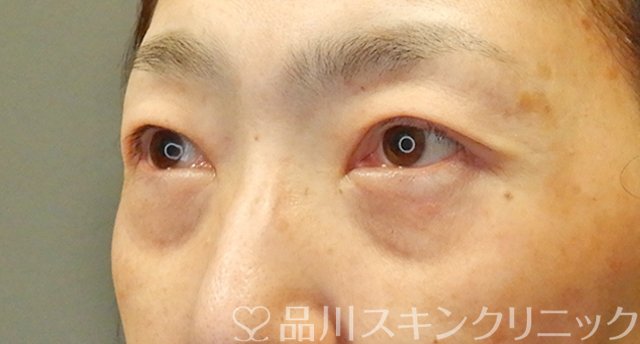 症例NO.66126のAFTER写真
